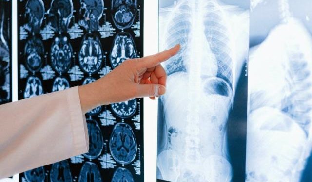 Ανακαλύφθηκε πρωτεΐνη που μπλοκάρει τη λοίμωξη κορονοϊού στους πνεύμονες