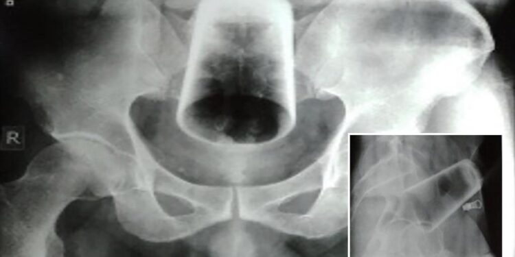 Άντρας στα επείγοντα με σφηνωμένο μέσα του ένα ποτήρι – Δεν πίστευαν οι γιατροί αυτό που είδαν στην ακτινογραφία