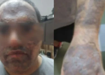 Ηράκλειο: Φρίκη για 22χρονο εργαζόμενο – Κάηκε από καυτό λάδι σε ξενοδοχείο