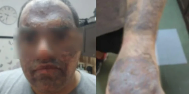 Ηράκλειο: Φρίκη για 22χρονο εργαζόμενο – Κάηκε από καυτό λάδι σε ξενοδοχείο