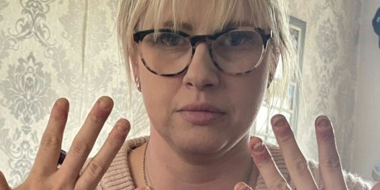 «Δεν μπορούσα να κουνήσω τα χέρια μου»: 36χρονη έπαθε ανεπανόρθωτη ζημιά από τζελ νυχιών & προειδοποιεί άλλες γυναίκες