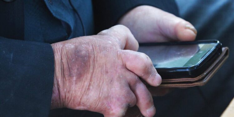 Συναγερμός: Επανεμφανίστηκε η λέπρα – Θα μπορούσε να γίνει ενδημική στη Φλόριντα