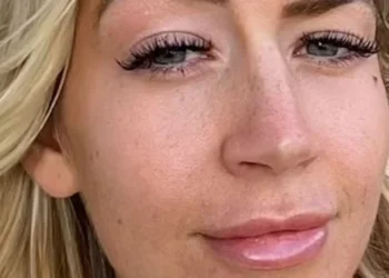 Πήγε να βγάλει το filler χειλιών και παρουσίασε αλλεργική αντίδραση – Ιδού πώς έγινε το πρόσωπό της μετά