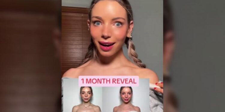 «Barbie Botox»: Η νέα τάση που σαρώνει στο TikTok – Προειδοποιούν οι ειδικοί