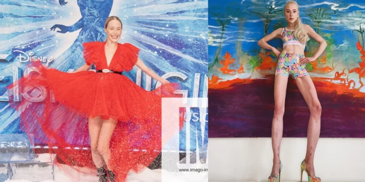 Ξόδεψε 149.000 ευρώ για να μακρύνει τα πόδια της -Έκανε δύο χειρουργεία, ψήλωσε 14 εκατοστά [εικόνες]