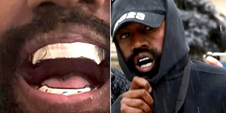 Κάνιε Γουέστ: Αφαίρεσε τα δόντια του και έβαλε μασέλα από τιτάνιο αξίας 850.000 δολαρίων