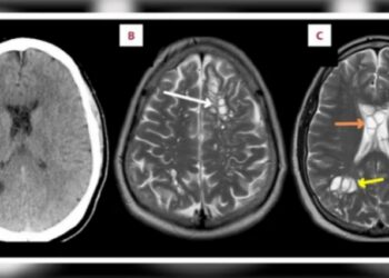 Άψητο μπέικον προκάλεσε σκουλήκια που έφτασαν στον εγκέφαλο 52χρονου Αμερικανού