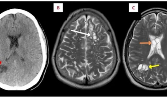 Άψητο μπέικον προκάλεσε σκουλήκια που έφτασαν στον εγκέφαλο 52χρονου Αμερικανού