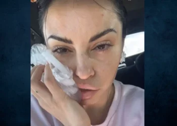 Δήμητρα Αλεξανδράκη: Ατύχημα στον δρόμο για το μοντέλo – Προσγειώθηκε η μπάρα στο κεφάλι μου, είπε