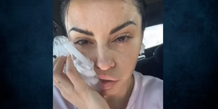 Δήμητρα Αλεξανδράκη: Ατύχημα στον δρόμο για το μοντέλo – Προσγειώθηκε η μπάρα στο κεφάλι μου, είπε