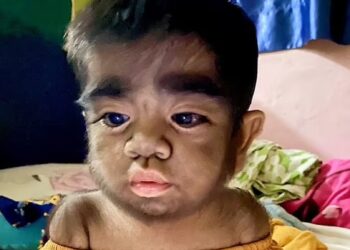 Φιλιππίνες: Έφαγε γάτα όταν ήταν έγκυος – Το παιδί γεννήθηκε «λυκάνθρωπος»