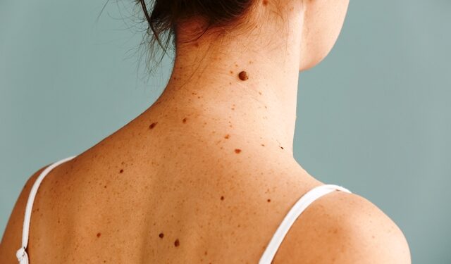 Μελάνωμα: Τα «ύποπτα» συμπτώματα και η σημασία της έγκαιρης διάγνωσης