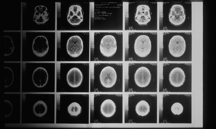 Καναδάς: Μεγάλη ανησυχία για εγκεφαλική νόσο που «χτυπά» νέους – Απαγόρευσαν σε ειδικό την έρευνα