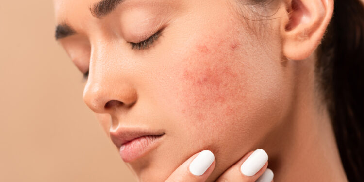 Acne Positivity Day: Η ακμή δεν επηρεάζει μόνο το δέρμα μας