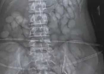 Επιβάτιδα συνελήφθη στο αεροδρόμιο του Γιοχάνεσμπουργκ καθώς οι αστυνομικοί βρήκαν «περίεργα» σημάδια στο στομάχι της