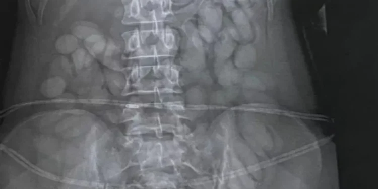 Επιβάτιδα συνελήφθη στο αεροδρόμιο του Γιοχάνεσμπουργκ καθώς οι αστυνομικοί βρήκαν «περίεργα» σημάδια στο στομάχι της