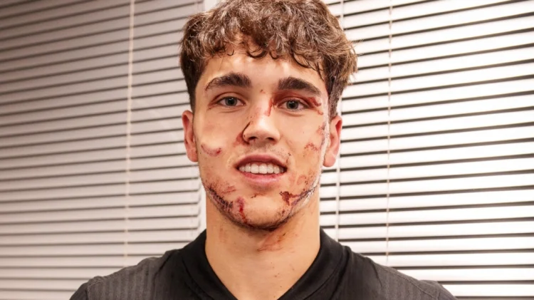 Μπαρτσελόνα: Ο 17χρονος Κουμπαρσί έκανε 10 ράμματα στο πρόσωπο μετά το ματς με τον Ερυθρό Αστέρα – Δείτε φωτογραφίες