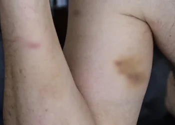 Επιχειρηματίας κατήγγειλε αστυνομικούς για ξυλοδαρμό στη Μύκονο: Τον πέρασαν για τοξικομανή – «Μου χτύπησαν το κεφάλι πάνω στην πόρτα»