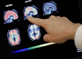 Πιο κοντά από ποτέ στο όνειρο: Επιστήμονες ανέστρεψαν το Αλτσάχαιμερ με νανοσωματίδια