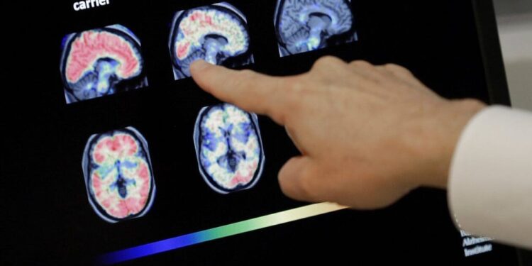 Πιο κοντά από ποτέ στο όνειρο: Επιστήμονες ανέστρεψαν το Αλτσάχαιμερ με νανοσωματίδια