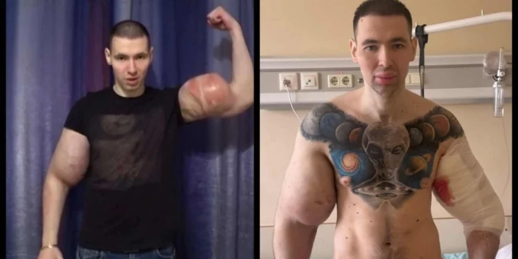 Ο «Ρώσος Ποπάι» κινδυνεύει να χάσει και τα δύο του χέρια μετά τις ενέσεις βαζελίνης που έκανε για να τα φουσκώσει (vid)