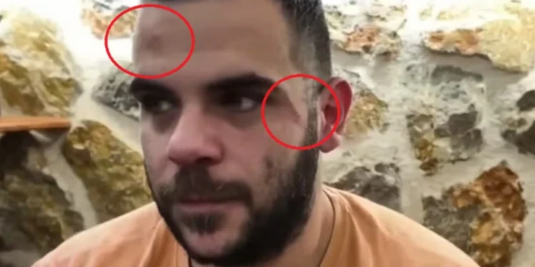 Ξυλοκόπησαν άγρια τον Youtuber Teosty σε live στα Γιάννενα: Τον χτύπησαν σε σώμα και πρόσωπο, εμφανίστηκε με μελανιές, δείτε βίντεο